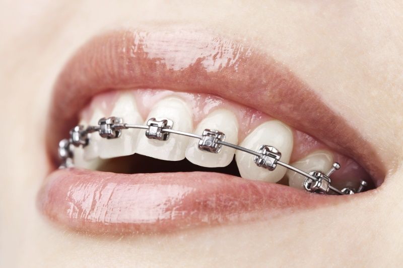 Types of dental braces