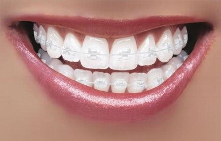 Types of dental braces