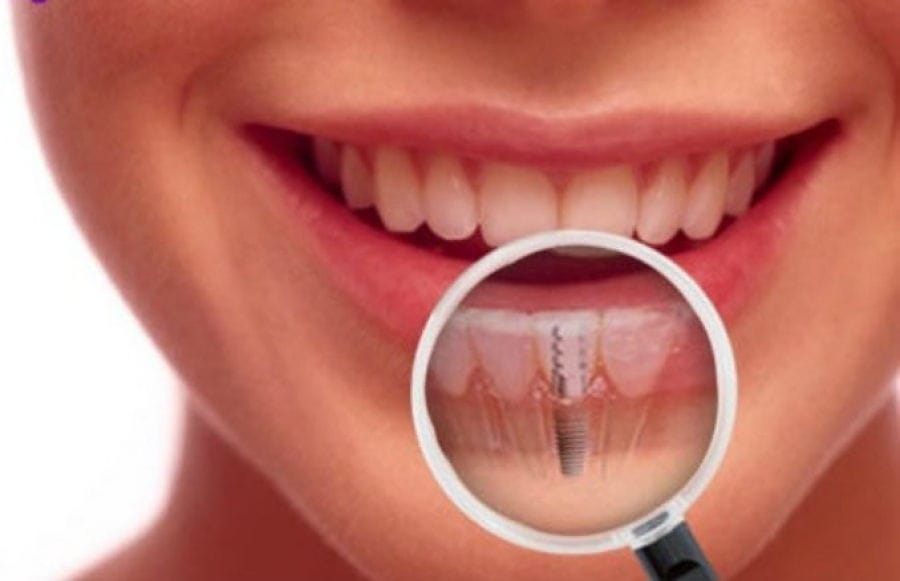 Implant dentar