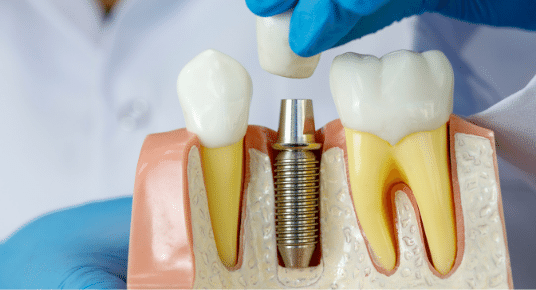 Implantul dentar