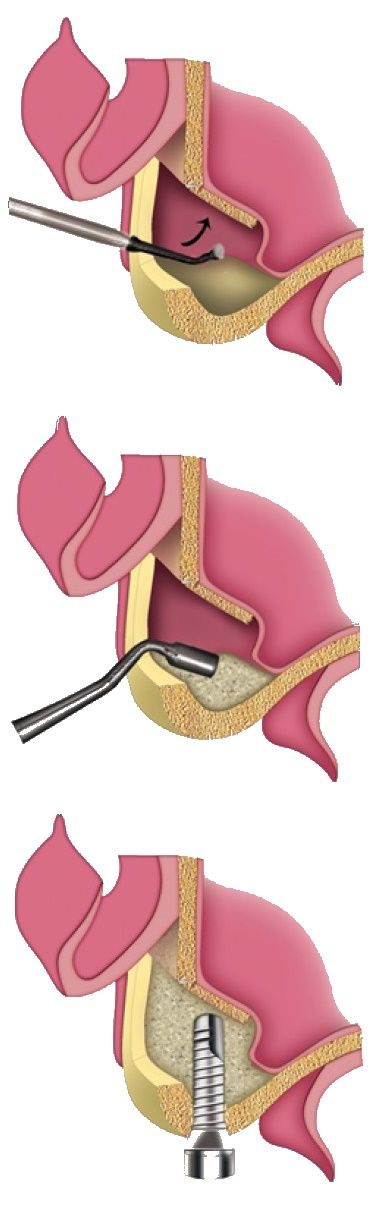 sinus lift implant dentar